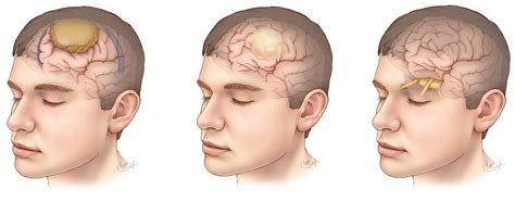 Types Of Benign Brain Tumors