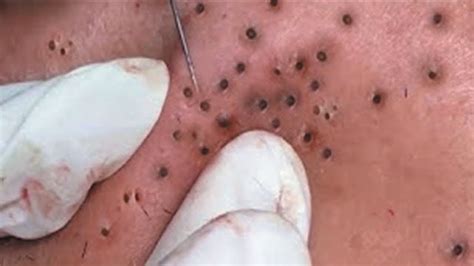 How are blackheads different to white heads? DISGUSTING CYSTS and BLACKHEADS Extraction Video - YouTube