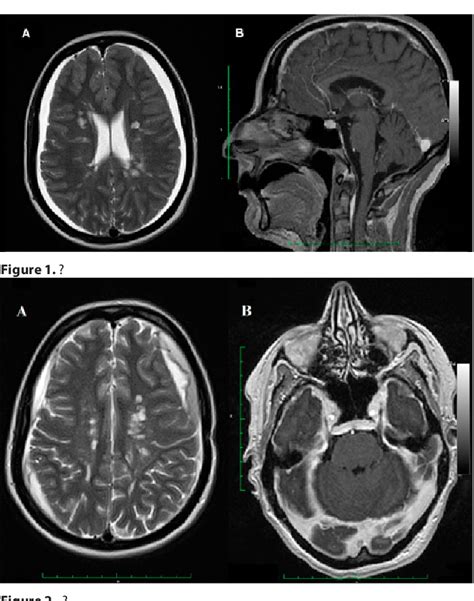 Figure From Subdural Haematoma Mimicking Empyema In A Patient With