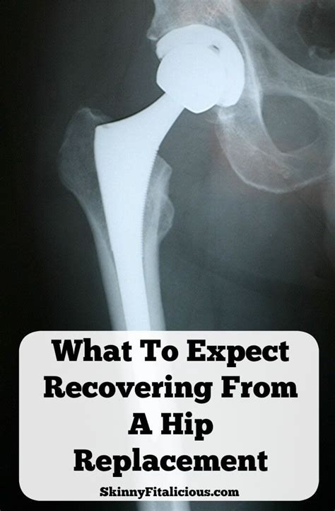What To Expect Recovering From A Hip Replacement Hip Replacement Hip