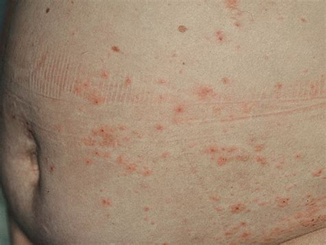 Pruritic Urticarial Papules And Plaques Of Pregnancy Puppp الحطاطات