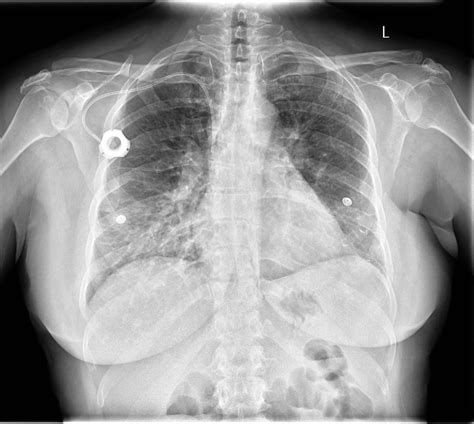 Lung Cancer And Chest Drains Pleural Fluid Nursing Culture Effusion