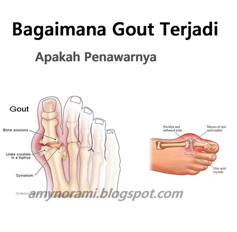 Buruk hati, maka buruklah keseluruhan hidup. Bagaimana Gout Terjadi Dan Apakah Rawatannya - amynorami.com