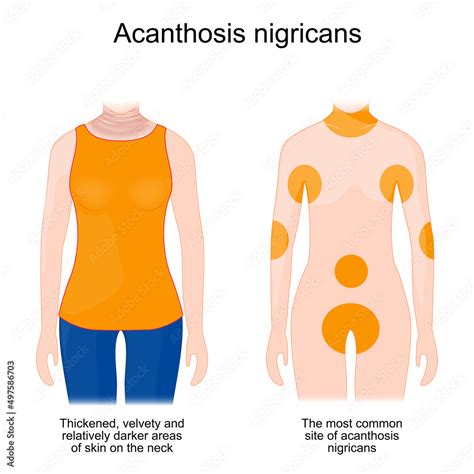 Acanthosis Nigricans Sign And Symptoms Stock Vector Adobe Stock