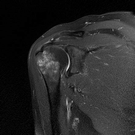 Greater Humeral Tuberosity Avulsion Fracture Image Radiopaedia Org