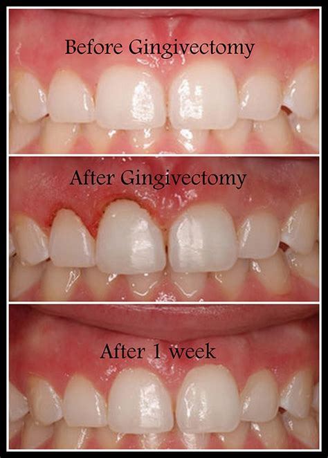 Gingivectomy Dr Sachdeva Dental Clinic Delhi New Delhi