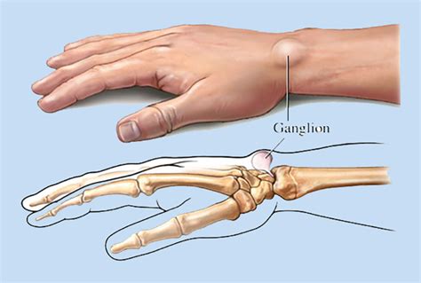 What Is A Ganglion Cyst Causes Symptoms And Treatments Images And Photos Finder