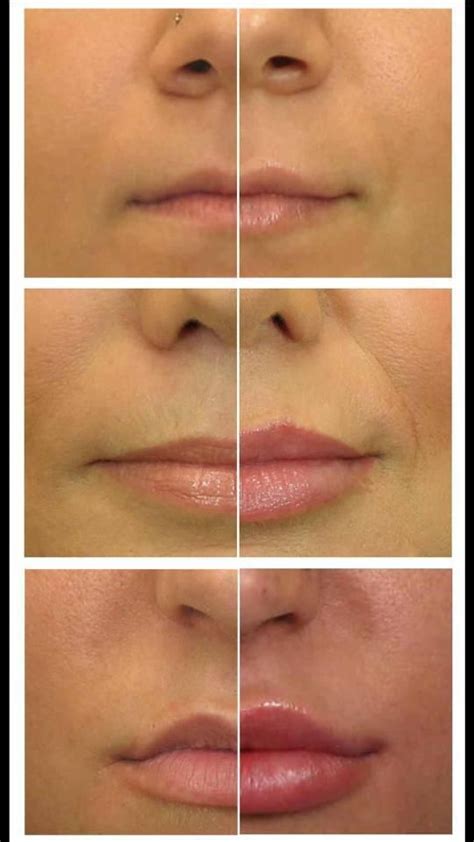 Before And After Lip Filler Juvederm Corpus Christi Health And Wellness