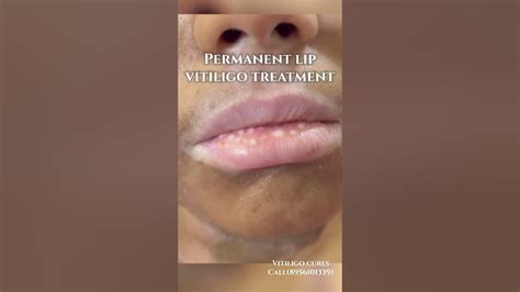 Permanent Lip Vitiligo Treatment Lips Safeddaag Ilaj Vitiligo Lip