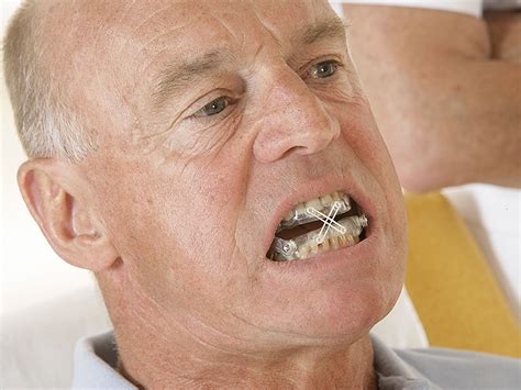 Oral Appliance Therapy In Osa A Better Way To Ensure Success