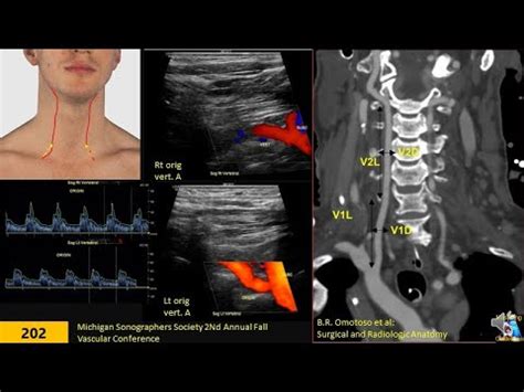 Vertebral Artery Ultrasound Youtube