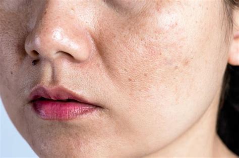 Can Dark Spots Be Treated Specialists In Dermatology Pllc Dermatologists