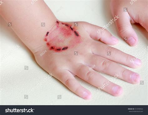 57 Wound On Childs Hand Sutured Images Stock Photos 3d Objects
