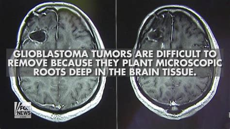 Mccain Brain Tumor What Is Glioblastoma Fox News