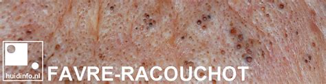 Extracting solar comedones favre racouchot for medical education nsfe. Favre-Racouchot | huidinfo.nl - uitleg van de dermatoloog