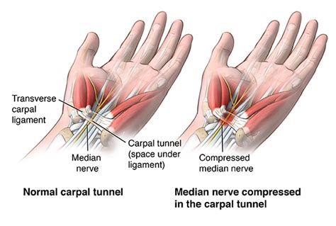 Carpal Tunnel Release Health Encyclopedia University Of Rochester