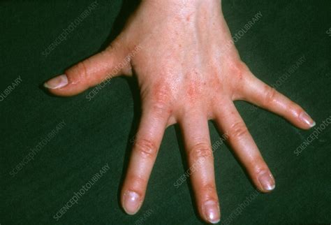 Scabies Rash On Young Womans Hand Stock Image M2600039 Science