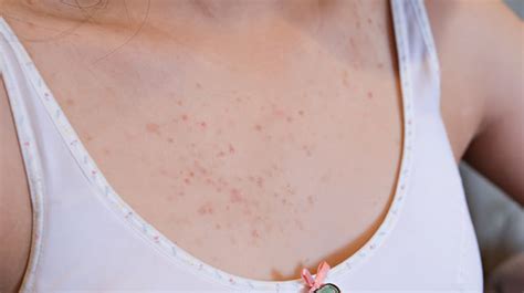 The Facts About Chest Acne Mayo Clinic Health System