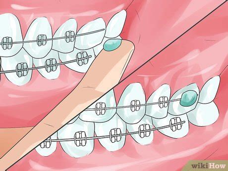 Ways To Handle Poking Wires On Braces Wikihow