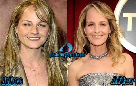 Helen Hunt Plastic Surgery Before And After Photos Plastic Surgery Facts