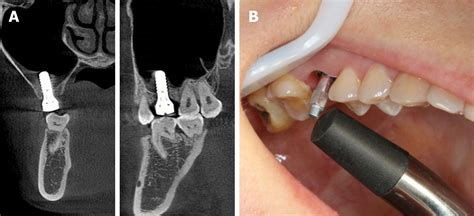 Minimally Invasive Endoscopic Maxillary Sinus Lifting And Immediate Implant Placement A Case Report