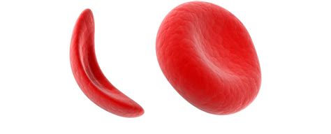 The defect forms abnormal hemoglobin. Combating Sickle Cell Disease with Cord Blood Stem Cells ...