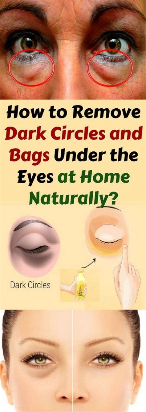 How To Remove Dark Circles And Bags Under The Eyes At Home Naturally Remove Dark Circles