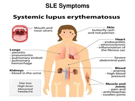Systemic Lupus Erythematosus Sle Lt33 Systemic Lupus Erythematosus