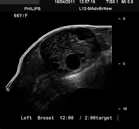 Panoramic Ultrasound Image Of The Left Breast Mass Download