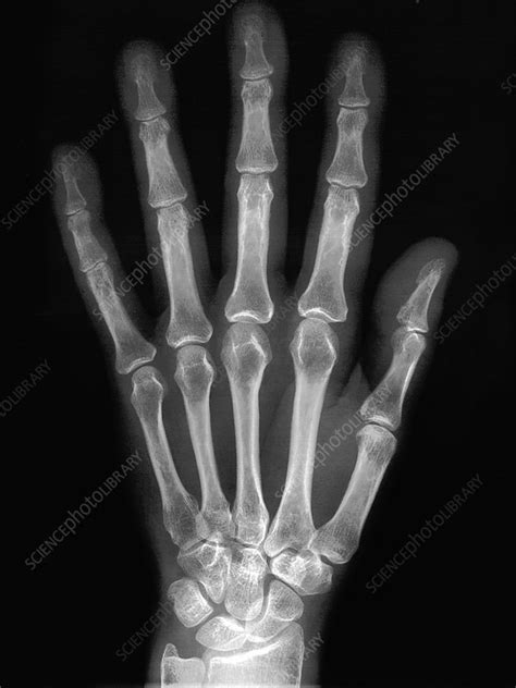 Normal Hand X Ray Stock Image C0272181 Science Photo Library
