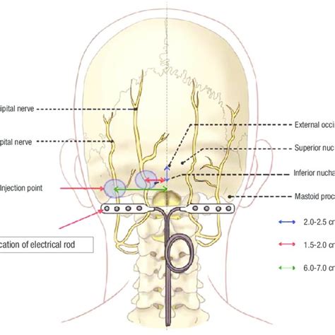 Landmarks For Injection Of The Occipital Nerves And Electrical