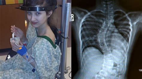 Halo Traction And Severe Scoliosis My 5th Surgery Youtube