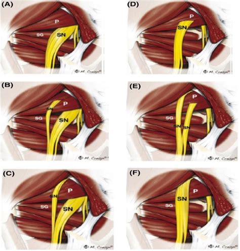 Anatomical Variation In The Relation Between Sciatic Nerve And Download Scientific Diagram