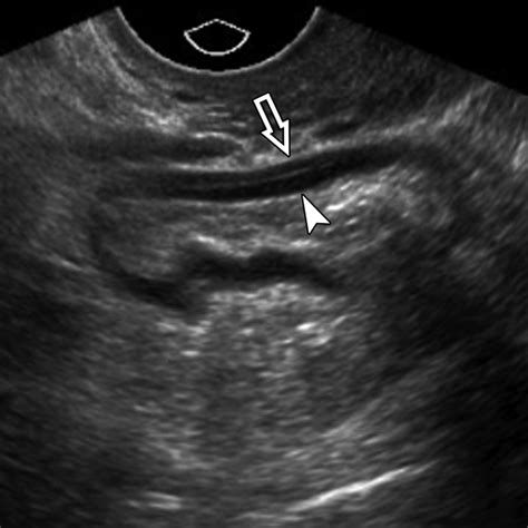 Ultrasound Imaging Of Bowel Pathology Technique And Keys To Diagnosis