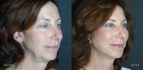 Facelifts Facialneckplasty The Pinch Patient 3 B Lorne K Rosenfield