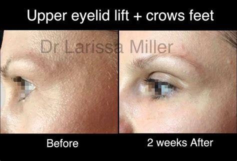 Anti Wrinkle Injections In Melbourne Vista Clinic