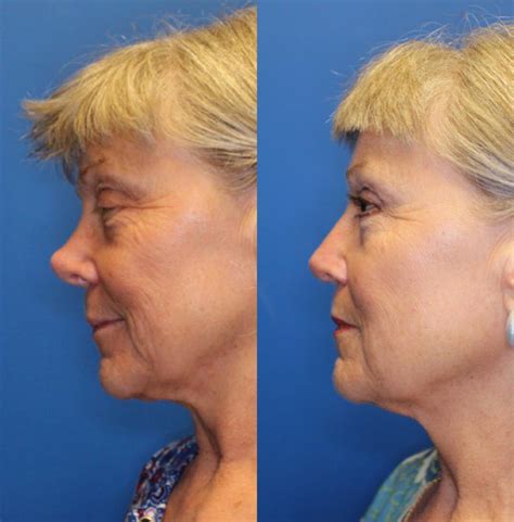 Nose Surgery Before And After Photos Patient 225 San Francisco Ca