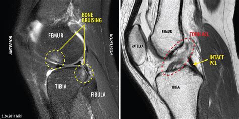 Inside My Knee Magnetic Resonance Imaging Mri Of My Left Flickr