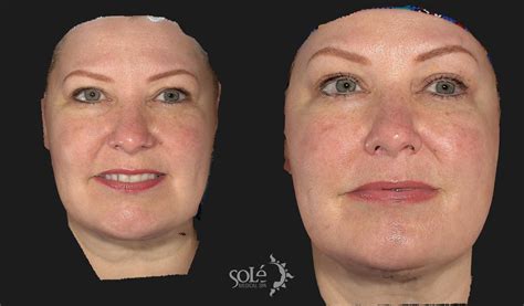 Botox And Dysport Before And After Pictures Case 67 Tifton Ga Solé