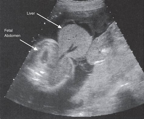 Fetal Imaging Obstetrical Complications Due To Pregnancy Williams
