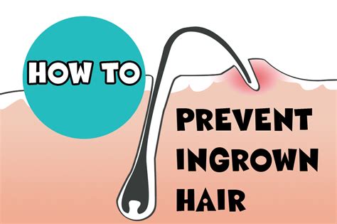 Understanding what ingrown hairs are is easy. Homemade Drawing Salve For Ingrown Hair - Homemade Ftempo