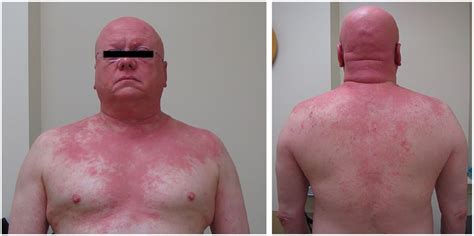 A Case Report Of Therapeutically Challenging Chronic Actinic Dermatitis