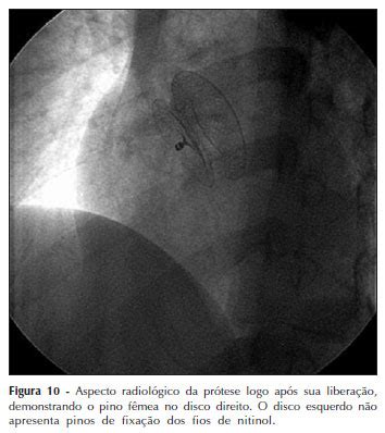 An opening in the upper part of the developing embryonic interatrial septum corresponding to the foramen ovale of the fetus. Experiência inicial no fechamento percutâneo da ...