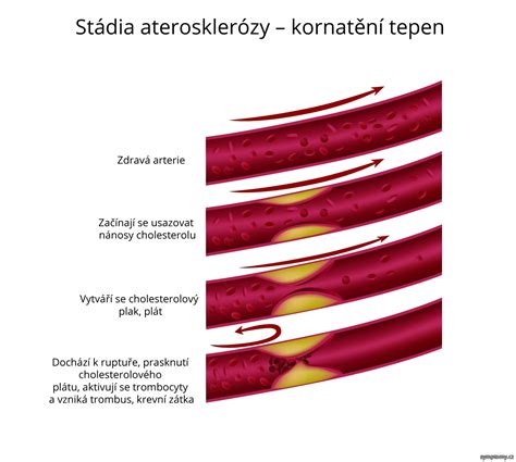 Ateroskleróza Příznaky A Léčba