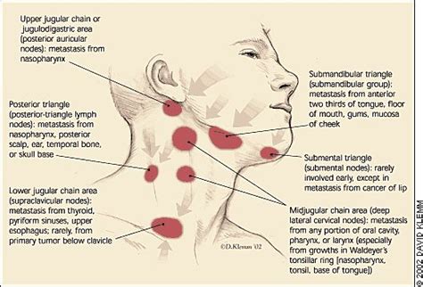Large Swollen Glands In Throat Swollen Lymph Nodes Lymph Nodes