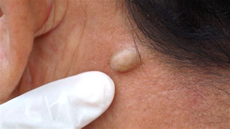 Why You Should Never Pop A Sebaceous Cyst At Home