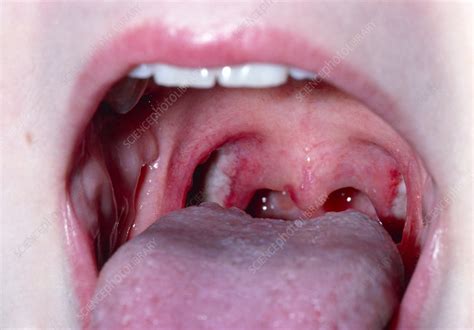 Patients Throat Ten Days After Tonsillectomy Stock Image M2700060