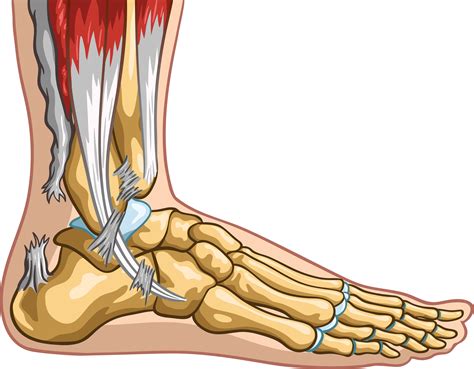 What Are Achilles Tendonitis And How To Fix Them Marietta Foot Doctor