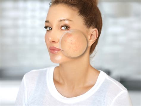 Effective Treatment Against Acne Scars Your Total Guide For Ladies