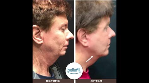 Results Check Out How Bellafill Can Help You Define Your Jawline